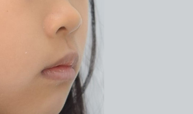 어린이 부정교합 교정 이후